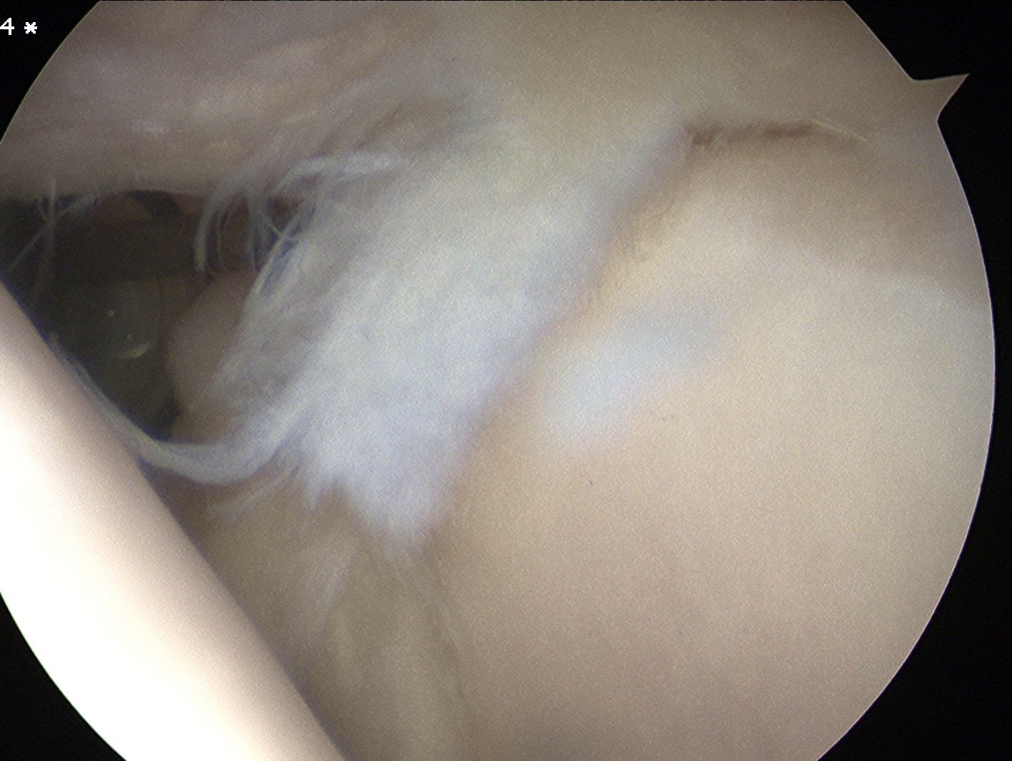 Type 4 SLAP Tear extends partially into biceps